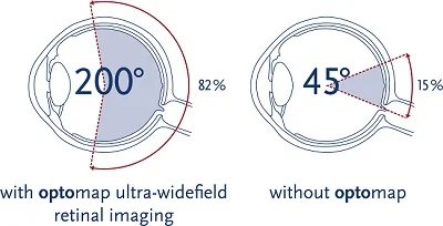 A photo explaining the difference of with and without optomap retinal imaging